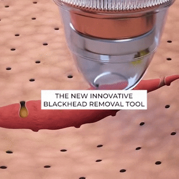 Electric Blackhead Remover – Suction Pore Cleaner & Beauty Tool